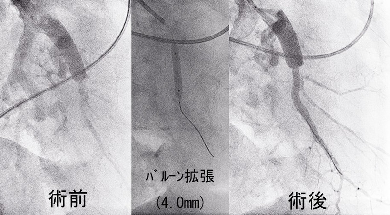 Arteria_pulmonary